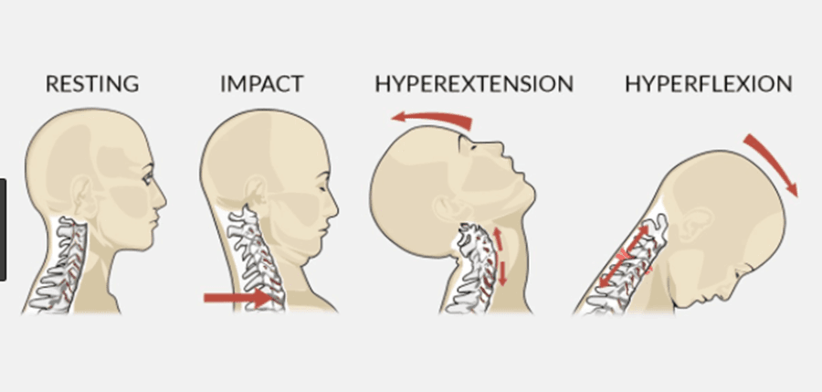 MPI physiotherapy, whiplash injury, car accident physiotherapy, Winnipeg physiotherapist